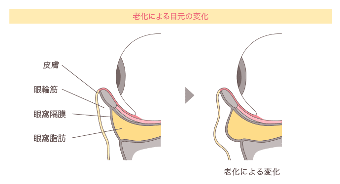 老化による目元の変化