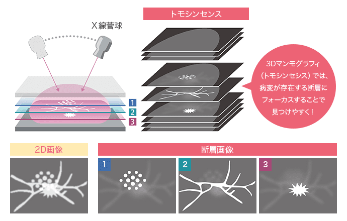 トモシンセンス 2D画像 断層画像