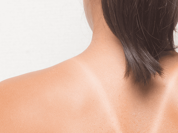 日焼けすると肌はどうなるの ビューティー ヘルスケア特集 Fujifilm ビューティー ヘルスケア Online