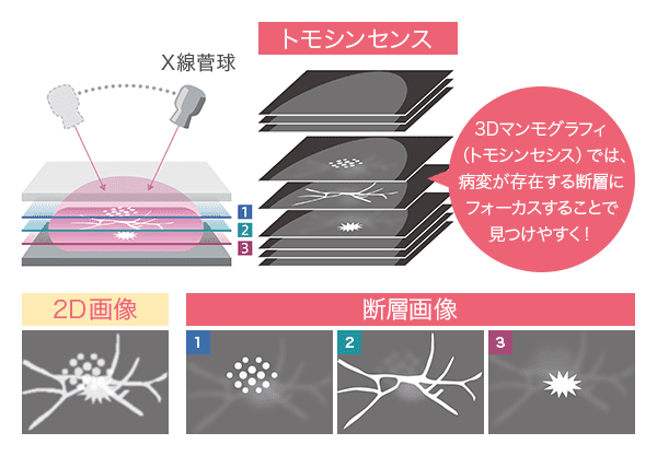 トモシンセンス 2D画像 断層画像