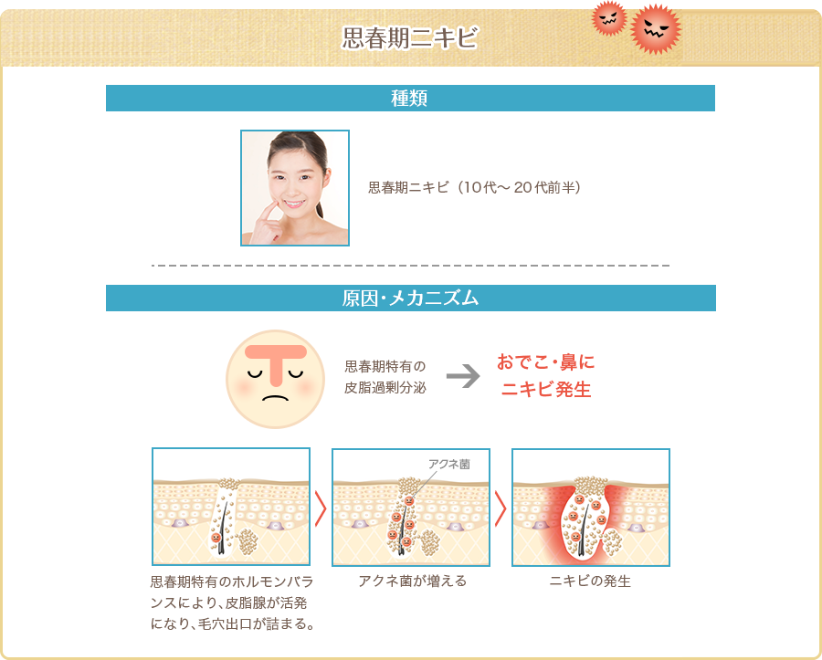 思春期ニキビ