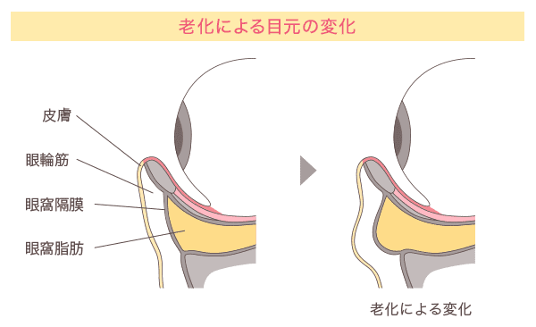 老化による目元の変化