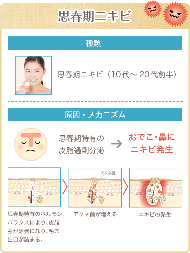 思春期ニキビ